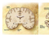 研究揭示了多种脑部疾病如何导致痴呆症