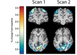 研究人员发布了一个新模型来预测大脑健康的改善
