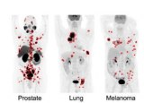 新型 AI 工具可通过全身 PET/CT 扫描准确检测出六种不同类型的癌症