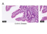 克罗恩病的发现可能有助于更好地治疗这种毁灭性疾病