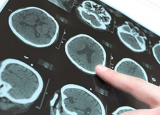 帕金森病中灰质萎缩与大脑连接组的结构和功能