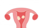 调查发现大多数患有子宫肌瘤的女性都接受子宫切除 而不是微创治疗